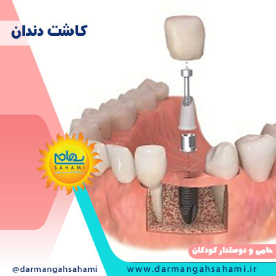 کاشت دندان در شیراز