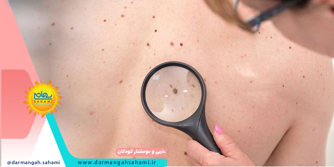 خال های پوستی