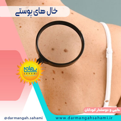 خال های پوستی