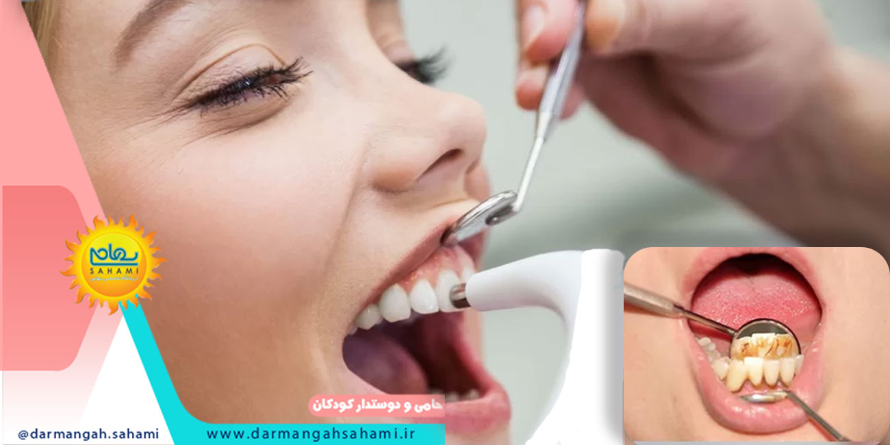 جرم گیری دندان کودکان در شیراز