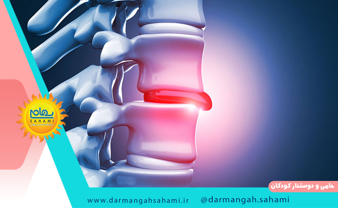 دیسک کمر در کجا واقع شده است؟