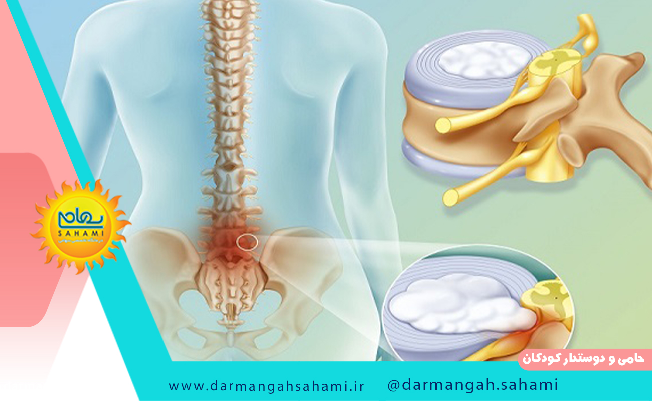 پیشگیری از بروز دیسک کمر